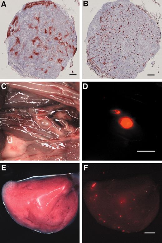Fig. 1. Quantification of hypoxia, vascular density, and metastasis in ME-180 orthotopic cervical tumors. A and B show immunohistochemical staining, as described in the text, for EF5 and CD31, respectively, on serial sections of a ME-180 orthotopic cervical tumor. Scale bars indicate 500 μm. C and E are brightfield images, and D and F are the corresponding fluorescent images, acquired on a Leica MZ FLIII stereomicroscope, after dissection of animals bearing orthotopic ME-180 DsRed expressing primary tumors. C and D show local lymph node metastases (primary tumor removed). Scale bar indicates 4 mm. E and F show an individual lung lobe in which metastatic lesions can be observed in the fluorescent image. Scale bar indicates 1 mm.