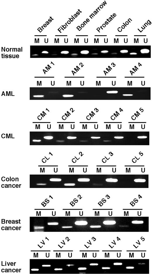 Fig. 3. Tazarotene-induced gene 1 (TIG1) promoter methylation in normal and cancer cells. Methylation-specific PCR of bisulfite-treated DNA from a panel of normal tissues and primary acute myelogenous leukemia (AML and AM), chronic myelogenous leukemia (CML and CM), colon (CL), breast (BS), and liver (LV) cancer tissues was performed (see Table 1<$REFLINK> for details). The methylated transcript generated with primers specific for methylated DNA was 118 bp, whereas the transcript generated with primers specific for unmethylated DNA was 134 bp. M and U represent the methylated and unmethylated fragments, respectively.