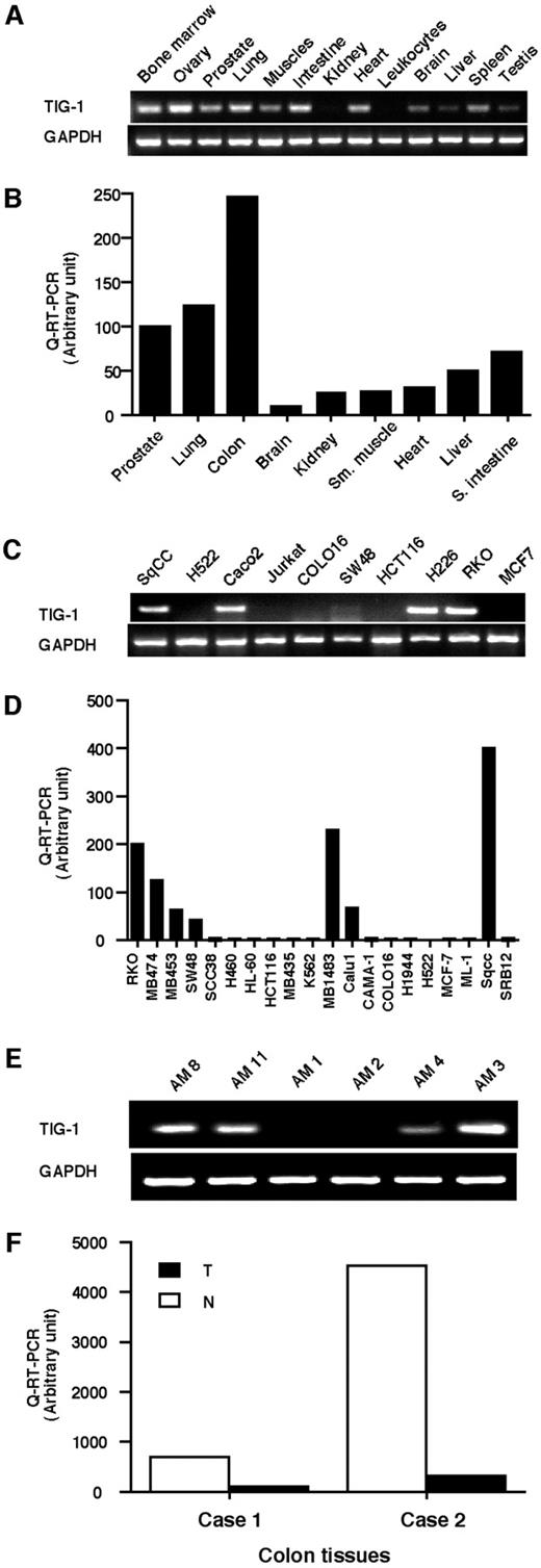 Fig. 4. Reverse transcription-PCR (RT-PCR) assessment of Tazarotene-induced gene 1 (TIG1) expression in normal tissues, cancer cell lines, and selected primary cancer samples. A, endogenous TIG1 expression in a variety of normal tissues as measured with conventional RT-PCR. B, expression of normalized TIG1 in a variety of normal tissues as measured using quantitative RT-PCR (Q-RT-PCR) as detailed in the “Materials and Methods” section. Sm., smooth; S., small. C, TIG1 expression in selected human cancer cell lines as measured by the conventional method as well as Q-RT-PCR (D). E, TIG1 expression in a panel of acute myelogenous leukemia (AM) tissues. Of note is the variation in the level of expression in relation to the internal control, glyceraldehyde-3-phosphate dehydrogenase (GAPDH). F, Q-RT-PCR for two primary colon tumors (T) with their normal adjacent tissues (N). Cases 1 and 2 are the same as those tested for methylation density in Fig. 2B<$REFLINK>. All samples tested with Q-RT-PCR in the present study were measured in triplicate. The SD for all tested samples varied from 0.1 to 0.9, with a mean SD of 0.2.