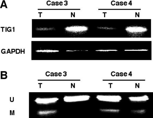 Fig. 5. Comparison between Tazarotene-induced gene 1 (TIG1) expression, as measured by reverse transcription-PCR (A), in two colon tumor pairs (T) with their adjacent normal tissues (N), and the corresponding TIG1 methylation, as measured by combined bisulfite restriction analysis (B). GAPDH, glyceraldehyde-3-phosphate dehydrogenase.