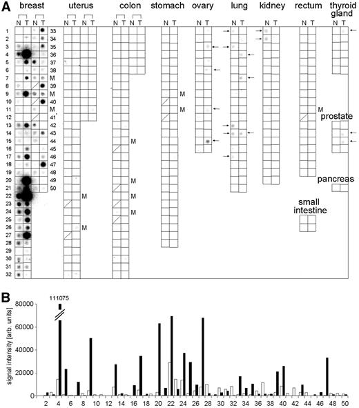 Fig. 4. Expression of CYP4Z1 in cancerous tissue samples and their corresponding normal tissues. A, cancer profiling array hybridized with a 32P-labeled probe. Tissue samples of each individual patient are localized on one row next to each other representing the cancerous tissue sample (right square) and its corresponding noncancerous tissue (left square). Arrows stress weak positive signals. B, densitometric determination of signal intensity obtained in (A) from breast cancer patients. Black bars, cancerous tissue; white bars, normal tissue. Patient numbers match in (A) and (B). N, noncancerous tissue samples; T, cancerous tissue samples; M, tissue sample of corresponding metastasis; Arb. unit, arbitrary unit.