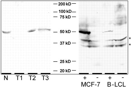 Fig. 5. Immunoblot analysis of CYP4Z1 expression. Whole cell lysates from mammary gland tissue (N), three breast carcinomas (T1-T3; 50 μg/sample), whole cell lysates from MCF-7 cells, and lymphoblastoid B cells (B-LCL; 3 × 105 cell equivalents) were subjected to SDS-PAGE and immunoblotting. MCF-7 and B-LCL cells transduced with retroviral particles containing either CYP4Z1-IRES2-enhanced green fluorescent protein (+) or IRES2-enhanced green fluorescent protein control vector (−). Invasive ductal carcinoma (T1), intraductal carcinoma (T2), invasive lobular carcinoma (T3). ∗, unspecific staining.
