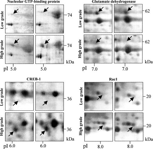 Fig. 2. Protein spots differentially expressed between low- and high-grade astrocytomas. Among 37 protein spots extracted by discriminant analysis with statistical significance, 4 representative protein spots are shown: nucleolar GTP-binding protein (upper left; 74.1 kDa; pI 5.04; P = 0.0283), glutamate dehydrogenase (upper right; 61.3 kDa; pI 7.26; P = 0.0063), cAMP-responsive element binding protein-1 (CREB-1; lower left; 36.6 kDa; pI 6.20; P = 0.0032), and Rac1 (lower right; 21.5 kDa; pI 8.10; P = 0.0001).