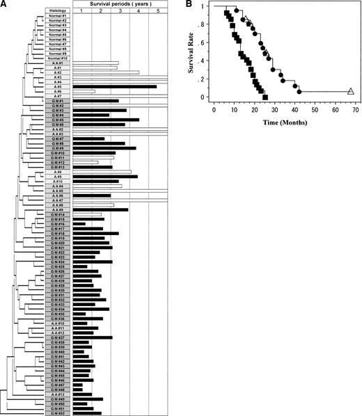 Fig. 3. A, hierarchical clustering based on proteome profiling data in the 75 glioma samples and 10 normal brain tissues. Each row represents a tissue sample, coding for the histological type of samples. Normal, normal brain tissue; A, astrocytoma; AA, anaplastic astrocytoma; GM, glioblastoma multiforme. The survival period of each patient is presented in the right-hand column: □ represents a surviving case; ▪ represents a patient who had died. The median follow-up period for the surviving patients was 3.5 years. B, the 52 patients with glioblastoma multiforme (GM) were divided into two groups according to the branching patterns of the hierarchical clustering and the squared Euclidean distance coefficients with reference to the normal brain tissues. Kaplan–Meier survival curve analysis of 21 patients with GM that clustered near the normal brain tissues (•; GM#1–GM#21 in A; coefficients <45.0) and the other 31 patients with GM that clustered relatively distant from the normal brain tissues (▪; GM#22–GM#52 in A; coefficients ≥45.0) is shown. The difference in the overall survival periods between the two groups was statistically significant (P < 0.001, log-rank test).
