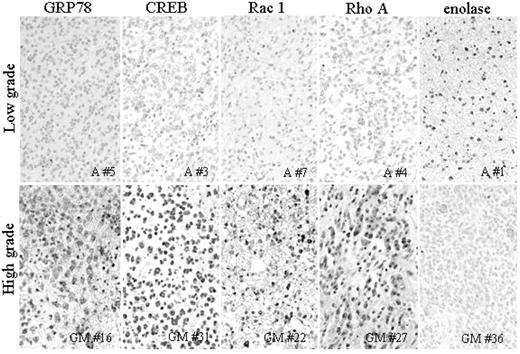 Fig. 5. Immunohistochemical analysis of the expression of GRP78, cAMP-responsive element binding protein-1 (CREB), Rac1, RhoA, and enolase in the paraffin-embedded sections of 10 cases: 5 cases with high-grade astrocytomas (GM#16, GM#22, GM#27, GM#31, and GM#36) and 5 cases with low-grade astrocytomas (A#1, A#3, A#4, A#5, and A#7). cAMP response element-binding protein-1 was detected in the nuclei of high-grade tumors but was weakly positive in low-grade tumors. GRP78, Rac1, and RhoA were abundantly expressed in the cytoplasm of high-grade tumors but were scarcely detected in low-grade tumors. In contrast, enolase was highly expressed in low-grade tumors compared with high-grade tumors.