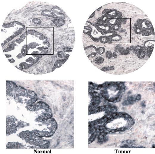 Fig. 5. KLK4 expression in normal and malignant prostate. An antisense riboprobe of KLK4 was used for in situ hybridization on a tissue microarray that contains both normal and tumor glands from human prostates. The sense probe did not result in any specific staining (data not shown). The KLK4 mRNA is predominantly detected in the basal cell layer of the normal prostate epithelium (left). The expression pattern is unordered and more intensive in the tumors (right). Two different magnifications are presented.