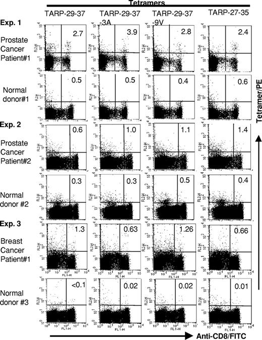 Fig. 8. HLA-A2 tetramers composed of wild-type and enhanced epitopes recognize peptide-specific CD8+ T cells in human blood samples. Tetramers of HLA-A2 and peptide were made as described in “Materials and Methods.” Peripheral blood mononuclear cells from breast and prostate cancer patients and normal donors were stained with anti-CD8-FITC and tetramer-PE and then analyzed by flow cytometry. A normal donor was tested simultaneously with each patient as a negative control. Data are representative of two repeated experiments with similar results.