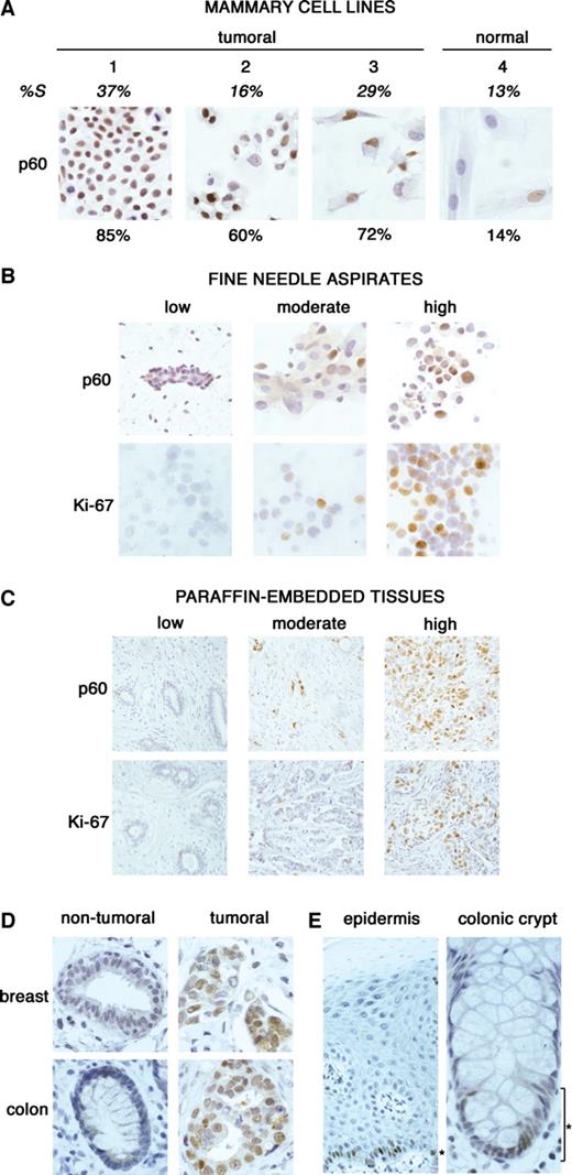 Fig. 5. Immunocytochemical and immunohistochemical detection of chromatin assembly factor (CAF)-1 p60. A, immunocytochemical detection of phosphorylated p60 (mAb8133) in the following four epithelial mammary cell lines: three tumoral MCF7 (1), T47D (2), Hs578T (3) and one normal Hs578Bst (4), compared with the percentage of replicating S-phase cells. Percentages of p60-stained cells obtained by counting at least 1000 cells for each cell line are indicated below. Magnification is 400×. B, immunocytochemical detection of Ki-67 and phosphorylated p60 (mAb8133) on fine needle aspirates from benign (low expression) and malignant breast lesions (moderate and high expression). Magnification is 400×. C, immunohistochemical detection of Ki-67 and phosphorylated p60 (mAb8133) in paraffin-embedded tissues from benign (low expression) and malignant breast lesions (moderate and high expression). Magnification is 200×. D, immunohistochemical detection of phosphorylated p60 (mAb8133) in paraffin-embedded tissues from breast and colon to compare tumoral and nontumoral tissues. Magnification is 400×. E, immunohistochemical detection of phosphorylated p60 (mAb8133) in paraffin-embedded tissues from normal skin (200×) and normal colon (400×). p60 expression in normal skin is restricted to the nuclei of basal and parabasal cells (∗). p60 expression in normal colon is restricted to the lower third of colonic crypts (∗). %S, percentage of cells in S-phase.