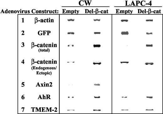 Fig. 1. Expression analysis of putative wnt/β-catenin target gene induction by mutant β-catenin overexpression. CWR22-Rv1 (CW) and LAPC-4 cells were infected with Del-β-catenin-expressing or control (Empty) adenovirus (multiplicity of infection = 10) for 24 h, after which RNA was prepared and subjected to RT-PCR to examine expression of aryl hydrocarbon receptor (AhR), TMEM2, and ALDH1A1. β-Actin and green fluorescent protein (GFP) expression levels were tested to verify equal input of RNA/cDNA into the assay and adenoviral transduction efficiency (GFP is encoded by AdTrack), respectively. In row 3, total β-catenin levels were detected using primers that do not discriminate between the endogenous and ectopic transcripts, whereas in row 4, the chosen primers do allow distinction between these two different β-catenin species (note that the ectopic transcript is smaller because of exon 3 deletion). Axin2 expression was tested to gauge the induction of a known β-catenin target gene (only CW cells were analyzed in this experiment). In separate transient transfection studies of Del-β-catenin overexpression, LAPC-4 cells showed a positive response in Axin2 RNA (data not shown). Amplified fragments were electrophoresed on 1.5% agarose gels and stained with ethidium bromide. Inverse light images are shown for clarity; although not reproduced in this figure, total β-catenin and basal levels of Axin2 were detected in LAPC-4 (row 3) and CW (row 5) cells, respectively.