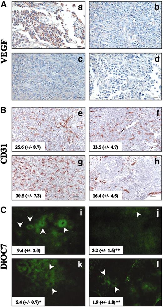 Fig. 5. Inhibition of phosphatidylinositol 3′-kinase/Akt and Raf/mitogen-activated protein kinase kinase/extracellular signal-regulated kinase pathways decreases vascular endothelial growth factor (VEGF) expression and tumor angiogenesis. A, VEGF staining of sections from paraffin-embedded 1984-1 tumors from severe combined immunodeficient mice topically treated with chemical inhibitors. B, CD31 staining of frozen sections of 1984-1 tumors from severe combined immunodeficient mice topically treated with chemical inhibitors. C, DiOC7 fluorescent staining of cells illuminating open vessels (white arrowheads) in 1984-1 tumors. Serial sections of tumors were stained with CD31 and DiOC7, and matching regions were compared. Treatments were as follows: a, e, and i, vehicle; b, f, and j, Ly294002; c, g, and k, U0126; d, h, and l, Ly294002 + U0126. VEGF, ×200X; CD31 and DiOC7, ×100. Bar, 50 μm. Numbers refer to average number of total microvessels/field ± SD (B) and number of open/functional microvessels/field ± SD (C). Significance has been calculated (Student’s t test): ∗∗, P < 0.001 (j and l); ∗, P < 0.05 (k).