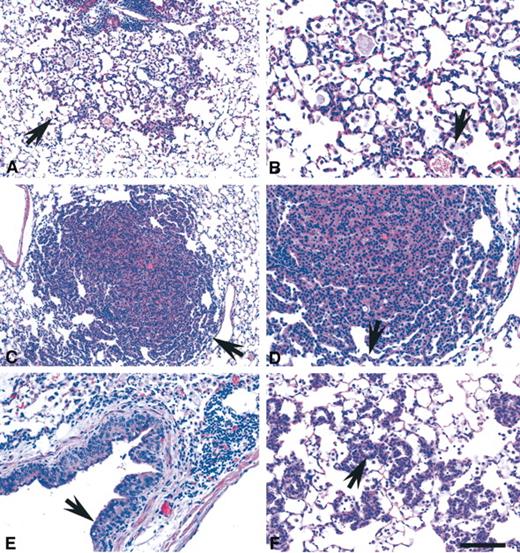 Fig. 1. Hyperplasia, benign, and preinvasive neoplasms of the mouse lung. A, focal spontaneous mouse epithelial hyperplasia in alveoli of a Swiss mouse (arrow). Boston lung workshop reference set number (LW) 082. B, higher magnification of the same section. Thickening of the alveolar septa due to lining by larger uniform cells with round to oval nuclei and moderate amount of eosinophilic cytoplasm. Mitotic figures are not seen. Some macrophages are present in the alveolar lumens (arrow). C, solid adenoma induced by urethane. LW040. The neoplasm is relatively well circumscribed and compresses adjacent normal lung parenchyma (arrow). D, higher magnification of the same section. Adenoma consists of a uniform population of epithelial cells with round nuclei and a moderate amount of eosinophilic cytoplasm. The solid areas may represent collapse of alveolar areas containing tumor cells and some extension into the adjacent alveoli (arrow). No mitotic figures are seen. E, squamous dysplasia in an airway of a mouse exposed to 3-methylcholanthrene. Atypical squamous cells replace most of the mucosa (arrow). LW071. F, atypical adenomatous hyperplasia in bitransgenic (transgenes Sp-C-GLp65 and UASG-FGF3) mice 1 week after FGF-3 induction by RU486. LW058. Many alveoli are lined by a uniform population of hypertrophic cuboidal cells sometimes forming glandular structures (arrow). H&E. ScanScope images. Calibration bar: A and C, 200 μm; B, D, E, and F, 100 μm.