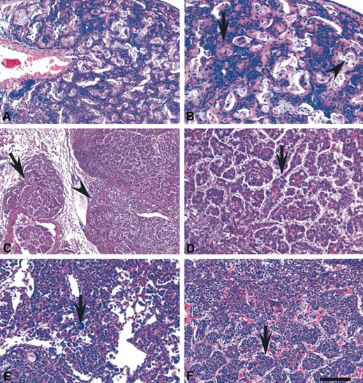 Fig. 2. Malignant neoplasms of the mouse lung. A, keratinizing squamous cell carcinoma induced by topical cutaneous administration of N-nitroso-tris-chloroethylurea. Boston lung workshop reference set number (LW) 070. B, higher magnification reveals that squamous differentiation is manifested by formation of keratin pearls (arrow) and dyscohesion of keratinizing cells (arrowhead). C, spontaneous papillary adenocarcinoma developed in a 25-month-old 129S4/SvJae mouse. LW003. In addition to papillary area with bronchiolar invasion (arrow), there is a less-differentiated area containing vacuolated tumor cells (arrowhead). D, higher magnification of the same section. Cells lining papillary stalks have vesicular nuclei with prominent multiple nucleoli. Mitoses are frequent (arrow). E, adenocarcinoma, not otherwise specified (NOS) in mouse with triple genetic modification (transgenes Tet-op-K-Ras4bG12D and CCSP-rtTA and targeted mutation p53−/−) 1 month after conditional activation of mutant K-rasby doxycycline administration. The neoplastic cells infiltrate alveolar septae and form aggregates in the alveolar lumen with presence of multinucleated bizarre cells (arrow). LW049. F, neuroendocrine carcinoma induced by recombinant adenovirus carrying Cre recombinase (AdCre)-mediated conditional inactivation of p53 and Rb1. LW011. Densely packed tumor cells with scant cytoplasm and finely granular chromatin form nests (arrow) with a fine vascular stroma. H & E, ScanScope images. Calibration bar: A, 200 μm; B, D, E, and F, 100 μm; C, 400 μm.