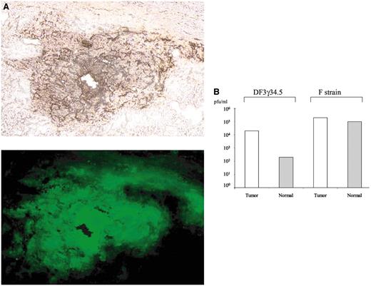 Fig. 4. Replication of F strain (wild type) and DF3γ34.5 in specimens of human liver and colon carcinoma. A, specimens of human liver containing colon carcinoma metastases were perfused with DF3γ34.5 and subjected to phase-contrast (top) or fluorescent (bottom) microscopy 72 h later. Photographs are ×100 magnification. Autofluorescence protein expression (green) is significantly greater in the central tumor nodule than in the surrounding normal liver. B, portions of the normal liver or colon cancer metastases that had been infused with either F strain or DF3γ34.5 were weighed, homogenized, and titered for infectious virus. pfu, plaque-forming units.