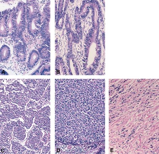 Fig. 1. Histological features of gastric carcinoma (GC) samples analyzed by serial analysis of gene expression. Formalin-fixed, paraffin-embedded sections were stained with H&E. Both W226T (A) and W246T (B) were to intestinal type GC, and histological features were similar. Both P208T (C) and P208L (D) were diffuse-adherent type GC. P208L was a lymph-node metastasis of P208T. S219T (E) was diffuse-scattered type GC. Obvious histological heterogeneity was not seen in all specimens (original magnification, ×100).