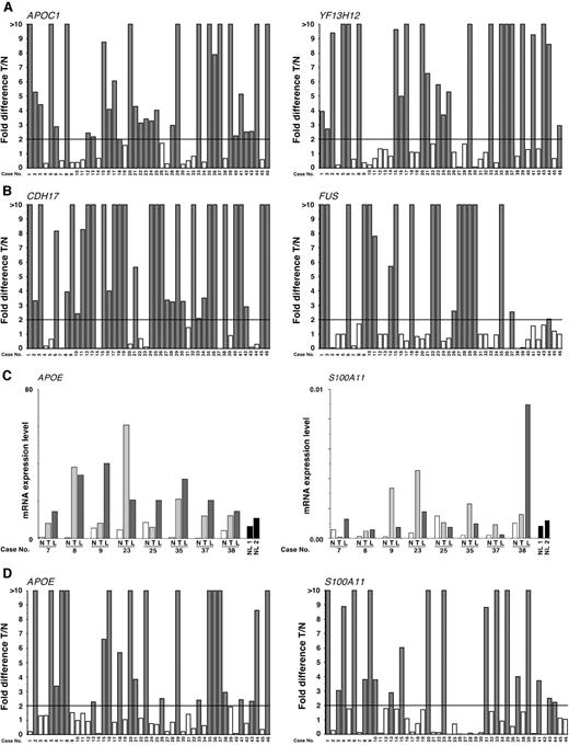 Fig. 3. Validation of serial analysis of gene expression (SAGE) data by quantitative reverse transcription-PCR (RT-PCR). Fold change indicates the ratio of target gene mRNA level in gastric carcinoma (GC) to that in corresponding nonneoplastic mucosa. A, quantitative RT-PCR analysis of genes commonly up-regulated according to SAGE analysis. Of the 46 GC samples, overexpression (T/n > 2) was detected at the following frequencies: 31 (67.4%) for APOC1 and 24 (52.2%) for YF13H12. B, quantitative RT-PCR analysis of genes potentially involved in tumor progression according to SAGE analysis. Of the 46 GC samples, overexpression (T/n > 2) was detected at the following frequencies: 34 (73.9%) for CDH17 and 19 (41.3%) for FUS. C and D, quantitative RT-PCR analysis of genes potentially involved in tumor metastasis according to SAGE analysis. C, mRNA expression levels of indicated genes in nonneoplastic mucosa, tumor, and lymph node metastasis. The units are arbitrary, and we calculated the target mRNA expression level by standardization to 1.0 μg of total RNA from HSC-39 as 1.0. T, tumor; n = nonneoplastic mucosa; L, lymph node metastasis; NL, normal lymph node from autopsy. D, mRNA expression levels of indicated genes in 46 GC samples. Of the 46 GC samples, overexpression (T/n > 2) was detected at the following frequencies: 23 (50%) for APOE and 19 (41.3%) for S100A11.