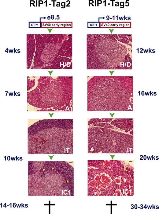 Fig. 1. Similar pathways to carcinoma formation unfold in different RIP1-Tag models of islet cell tumorigenesis. H&E-stained sections reveal similar histopathological stages of islet cell tumorgenesis elicited by the RIP1-Tag transgene, which targets the SV40 large T and small t antigens to the β cells of the endocrine pancreas. In the RIP1-Tag2 line, the transgene is activated at embryonic day 8.5, and expression is constitutively maintained thereafter. In the RIP1-Tag5 line, expression is first detected in scattered β cells at 9–11 weeks of age. Although the ontogeny of oncogene activation is very different in the two transgenic lines, hyperplastic/dysplastic islets (H/D), angiogenic islets (A), islet tumors (IT), and invasive carcinomas (IC1) arise with decreasing frequency over similar time intervals. The scale bar is 40 μm.