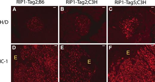 Fig. 3. T-antigen expression levels are variable in the β cells of the RIP1-Tag2 and RIP1-Tag5 transgenic mouse lines. Immunofluorescent labeling with an anti-T-antigen rabbit polyclonal antibody of hyperplastic/dysplastic (H/D; A–C) islets and invasive carcinomas (IC-1; D–F) from RIP1-Tag2/B6 (14 weeks), RIP1-Tag2/C3H (16 weeks), and RIP1-Tag5/C3H (32 weeks) animals. Variable T-antigen levels were observed in all three transgenic lines at all stages of tumorigenesis; tumor cells within neoplastic lesions of all stages in the RIP1-Tag5C3H lines tended to exhibit somewhat higher levels of expression. E in D–F, exocrine pancreas, which does not express the transgene and is found intermixed with tumor cells within the invasive fronts of the IC-1 grade of islet carcinoma. The scale bar is 40 μm.