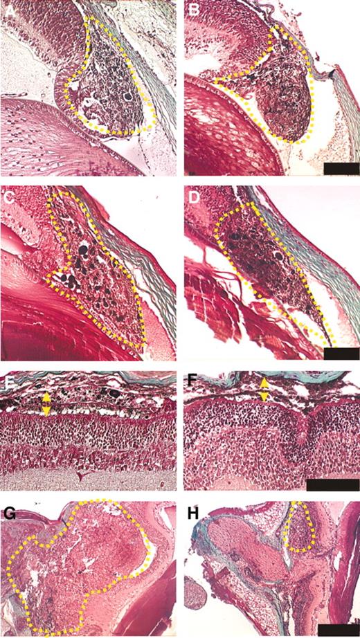 Fig. 1. Tumor development of tyrp1-Tag and bigenic mice at early stage. A and B, Ora serrata at dpn 4; C and D, Ora serrata at dpn 15; E and F, median part at dpn 15; G and H, posterior area at dpn 15. A, C, E, and G, Tyrp1-Tag; B, D, F, and H, bigenic. Scale bar in E and F = 100 μm and in G and H = 300 μm.