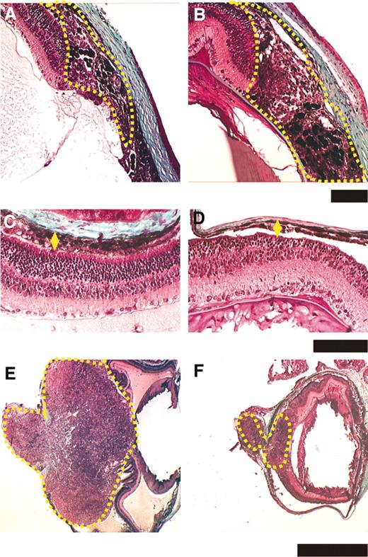 Fig. 2. Tumor development of tyrp1-Tag and bigenic mice at later stage. A and B, Ora serrata; C and D, median part; E and F, posterior area at 1 month post-natal (pn). A, C, and E, Tyrp1-Tag; B, D, and F, bigenic. Scale bar in A–D = 100 μm and in E and F = 1000 μm.