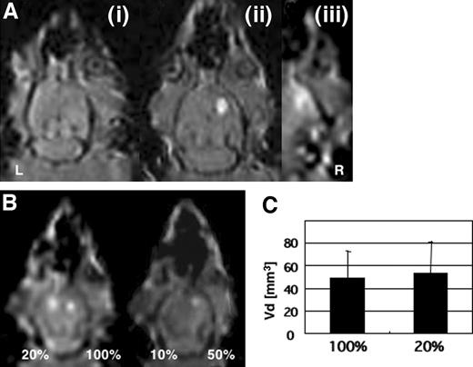 Fig. 1. A, T1-weighted axial magnetic resonance image of an intact normal rat (i), a rat given a convection-enhanced delivery infusion of Lip/Gd/DiI-DS into the right hemisphere and a convection-enhanced delivery infusion of Lip/DiI-DS into the left hemisphere (ii), and a rat given gadodiamide solution at the same concentration as that for Lip/Gd/DiI-DS into the right hemisphere [20-μl vehicle containing 4.7 mm Gd (iii)]. Magnetic resonance imaging (MRI) was performed 2 h after infusion. The signal from Gd-containing liposomes was detected, whereas Lip/DiI-DS could not be detected. The signal from the gadodiamide solution revealed more diffuse distribution. B, the concentration of Lip/Gd/DiI-DS detectable with MRI was estimated. Dilutions down to 20% were detectable with a similar distribution volume; however, the signal intensity from 10% Lip/Gd/DiI-DS was insufficient. Lip/Gd/DiI-DS containing 4.7 mm Gd was used for the study. C, the volume of distribution as calculated from MRI of the rats receiving a 20% concentration of Lip/Gd./DiI-DS (n = 6) was almost the same as that of the rats receiving a 100% concentration (n = 11).