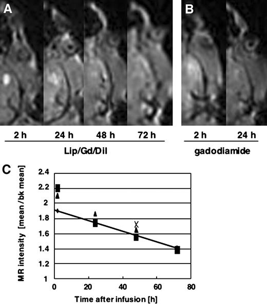 Fig. 3. A, T1-weighted axial magnetic resonance (MR) image showing time-course changes after convection-enhanced delivery infusion of 20 μl of Lip/Gd/DiI-DS. Gd signals were detected even after 72 h of infusion. B, T1-weighted axial MR image showing time-course changes after infusion of gadodiamide solution. As compared with the Lip/Gd/DiI-DS, gadodiamide solution distributed rapidly initially and washed out earlier. C, change in MR signals after Lip/Gd/DiI-DS infusion. Mean MR intensity of the distributed area was standardized with the background (bk) mean MR signal intensity and plotted against the time after infusion. Line, regression line; R2 = 0.9905.