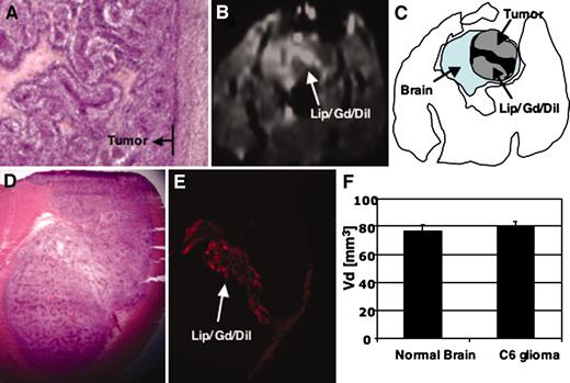 Fig. 5. Convection-enhanced delivery infusion of Lip/Gd/DiI-DS in the C6 glioma rat brain tumor model. A, histological image of a C6 glioma implanted into the brain of Sprague Dawley rat shows a heterogeneous tumor with necrosis inside and a relatively clearly encapsulated border (H&E staining). B, T1-weighted coronal magnetic resonance image after the infusion of 20 μl of Lip/Gd/DiI-DS into a C6 glioma on day 16 after implantation. C, illustration depicting B: the brain is the light blue area; the C6 glioma tumor is gray; and the infused liposome is shown as the black region. Liposomes, when infused into this heterogeneous C6 glioma tumor, became distributed in an irregular shape and leaked into the encapsulated tumor margin. D, histological image (H&E staining) made after infusion shows a large tumor. E, fluorescence generated from DiI-DS in the same section. The distribution pattern and shape were comparable with that observed in B. F, the volume of distribution in the tumor mass, as calculated from histological analysis and compared with that achieved in normal brain, showed almost the same volume of distribution in tumor and normal brain.
