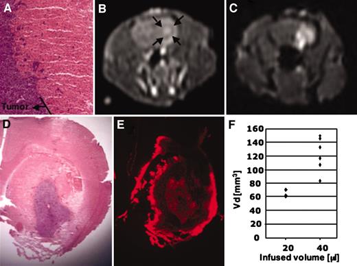 Fig. 6. Convection-enhanced delivery infusion of Lip/Gd/DiI-DS into a 9L-2 glioma rat brain tumor model. A, histological image of a 9L-2 glioma grown in the brain of Fisher 344 rat shows a relatively homogeneous tumor with invasive characteristics (H&E staining). B, on day 9, this T1-weighted spin echo magnetic resonance image was obtained after i.p. injection of a contrast agent. C, on day 10, 40 μl of Lip/Gd/DiI-DS were infused by convection-enhanced delivery. Almost the whole tumor mass was covered with Lip/Gd/DiI-DS. D, histological image of the tumor after infusion of liposomes (H&E staining). E, DiI-DS distribution was detected in this section. Almost the whole brain tumor and the surrounding normal brain were covered with Lip/Gd/DiI-DS. F, the volume of distribution detected by magnetic resonance imaging in the 9L-2 tumor-bearing rat brain. Three rats received a 20-μl infusion, and 9 rats received a 40-μl infusion. The distribution was similar to that in normal brain, as shown in Fig. 2B<$REFLINK>.