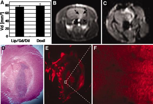 Fig. 7. Infusion of Gd-loaded liposomes mixed with Doxil for convection-enhanced delivery. A, Lip/Gd/DiI-DS (20 μl) and Doxil (20 μl) were infused in normal intact Sprague Dawley rats (n = 3 for each group). The volume of distribution was calculated by histological detection of the fluorescence generated from DiI-DS in the Lip/Gd/DiI-DS and the fluorescence generated from Doxil itself. The volume of distribution was almost the same for Lip/Gd/DiI-DS and Doxil. B, T1-weighted coronal magnetic resonance image of a 9L-2 rat brain tumor made with contrast enhancement on day 9 after tumor implantation. C, a mixture of Lip/Gd (20%) and Doxil (80%) was infused with convection-enhanced delivery in three rats on day 10. The total volume infused was 40 μl. D, histological image (H&E staining) made after infusion. E, fluorescence generated by Doxil in the same slice covers almost the whole tumor mass. F, higher magnification of highlighted area of E (×100).