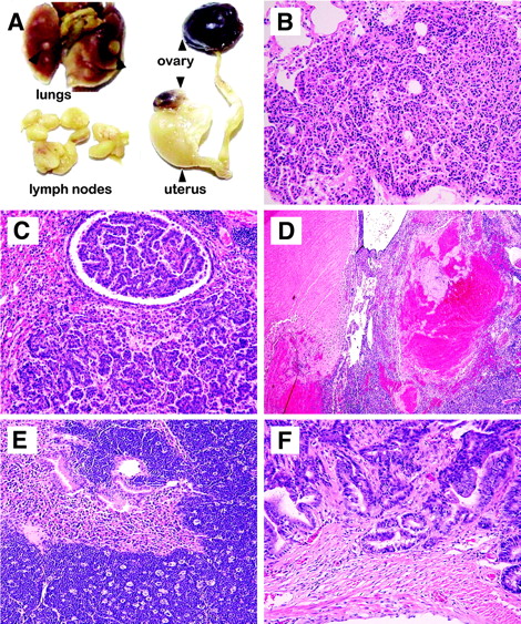 Fig. 4. Histological sections of tumors in Myh−/−Ogg1−/− and Myh−/−Ogg1−/−Msh2+/− mice. A, gross tumors in Myh−/−Ogg1−/− mice. Lung tumors, bilateral ovarian tumors, and left uterine horn with tumor (right uterine horn is normal), as indicated by arrows, and lymphomas in lymph nodes. B, lung adenoma in Myh−/−Ogg1−/− mice. C, lung adenocarcinoma in the airway and lung tissue in Myh−/−Ogg1−/−Msh2+/− mice. D, ovarian hemangioma in Myh−/−Ogg1−/− mice. E, lymphoma infiltration in the lung of Myh−/−Ogg1−/− mice. F, intestinal adenocarcinoma in Myh−/−Ogg1−/− mice.