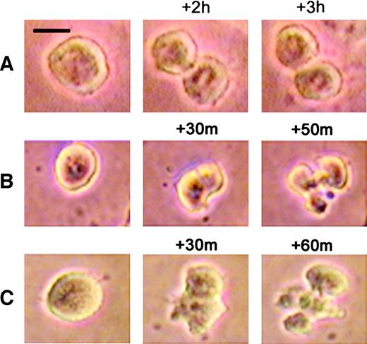 Fig. 3. Time-lapse microphotography of malignant melanoma cells exposed to TTFields. A, an example of a cell in mitosis arrested by TTFields. Contrary to normal mitosis, the duration of which is less than 1 h, the depicted cell is seen to be stationary at mid-cytokinesis for 3 h. B and C, two examples of disintegration of TTFields-treated cells during cytokinesis. Three consecutive stages are shown: cell rounding (left); formation of the cleavage furrow (middle); and cell disintegration (right). Scale bar = 10 μm.