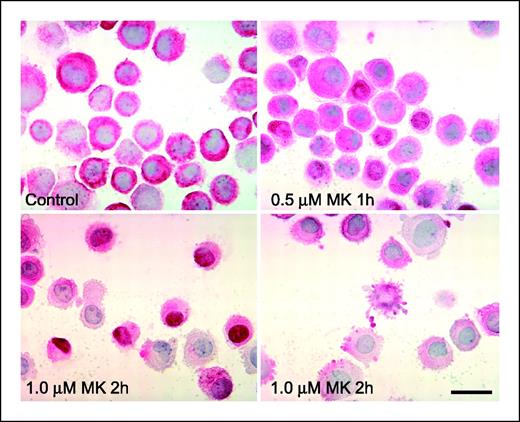 Figure 4. PPARγ cellular redistribution after treatment with MK886. Immunocytochemical analyses were done using a polyclonal antibody to PPARγ in A549 cells after exposure to increasing concentrations of MK886. After 1 hour, translocation of PPARγ immunoreactivity to the nucleus was observed. After 2 hours clear evidence of apoptosis was observed. Bar, 10 μm.