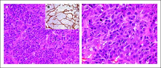 Figure 2. A and B, a representative section (20× objective) and its higher magnification (60× objective) of tumor grown in SCID mice following the injection of isolated CD44+/CD24− cells (H&E). Macronucleated malignant cells showed dark basophilic (§) or pale and vacuolated (*) cytoplasm. In some areas, erythrocytes are visible within tumor cell–lined cavities (arrows). C, tumor sections display high vessel density as shown by anti–factor VIII staining (10× objective).