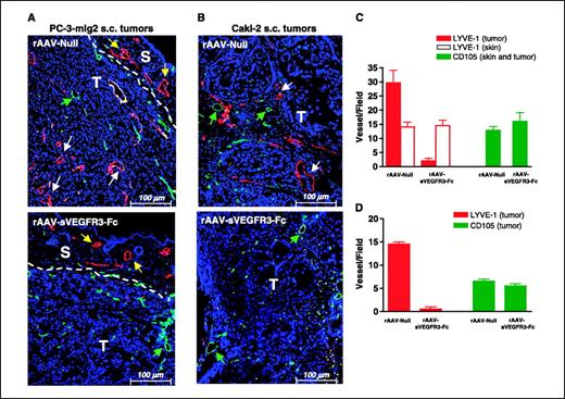 Figure 5. rAAV-sVEGFR3-Fc inhibits tumor-associated lymphangiogenesis but not angiogenesis in PC-3 prostate and Caki-2 renal carcinoma tumor models. At 3 weeks following tumor implantation, PC3-mlg2 (A) and Caki-2 (B) primary tumors from control (top) and rAAV-sVEGFR3-Fc–treated (bottom) mice were harvested and analyzed for lymphatic vessels using a murine LYVE-1 antibody (red staining) and for blood vessels using a murine CD105 antibody (green staining) by immunohistochemistry. Tissue sections were counterstained with DAPI (blue). Dotted line, tumor-stroma boundary where “T” represents the tumor tissue and “S” represents the adjacent normal skin. LYVE-1+ lymphatic vessels (white arrows) were observed within the tumor in control-treated specimens and were completely devoid within the tumor periphery in rAAV-sVEGFR3-Fc–treated tumors. LYVE-1 staining within the normal skin adjacent to the tumor periphery showed no difference in the density of preexisting lymphatic vessels (yellow arrows) following rAAV-sVEGFR3-Fc treatment compared with control tumor sections. The density of CD105+ tumor-associated blood vessels (green arrow) was similar in rAAV-sVEGFR3-Fc–treated tumor tissues compared with the controls. C and D, mean ± SE number of immunostained vessel structures was enumerated from nine serial sections of four representative PC-3-mlg2 tumors (C) and two representative Caki-2 tumors (D) in each experimental group. PC-3 tumors: P = 0.0001 for LYVE-1, P > 0.5 for CD105; Caki-2 tumors: P = 0.0001 for LYVE-1, P > 0.3 for CD105.