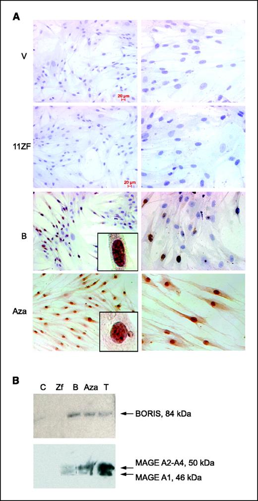 Figure 2. Immunohistochemical analysis of BORIS expression in normal primary human fibroblasts treated with BORIS expression vector or 5-azadC. A, cells were fixed with methanol, permeabilized with Triton X-100, and incubated with ap-2-ab chicken antibodies specific for BORIS protein and then secondary horseradish peroxidase conjugates. Original magnification, ×10 (left) and ×40 (right). V, control fibroblasts transfected with empty vector; 11ZF, fibroblasts transfected with plasmid expressing BORIS/CTCF zinc finger domain only; B, fibroblasts transfected with BORIS expression plasmid; Aza, cells treated with 1 μmol/L 5-azadC for 3 days. B, Western blot analyses of BORIS and several MAGE family proteins in control fibroblasts transfected with empty vector (lane C), in the same fibroblasts transfected with the vector for the 11ZF domain of CTCF/BORIS (lane Zf) or with the full-length BORIS expression plasmid (lane B), and in cells treated with 1 μmol/L 5-azadC (lane Aza). Total protein lysate from normal adult human testis was also included as a positive control (lane T). Human BORIS protein is represented by a 84-kDa band (top). Expression of MAGE-A proteins was detected by monoclonal antibody 6C1 (these antibodies detect both MAGE-A1 and MAGE-A2).
