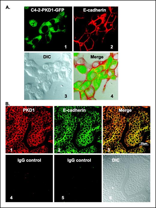 Figure 5. Colocalization of PKD1 with E-cadherin at cell junctions in C4-2-PKD1-GFP cells and in human prostate cancer tissue. A, colocalization of PKD1 with E-cadherin in C4-2-PKD1-GFP cells. The cells were cultured on glass coverslips and immunostained with E-cadherin antibody and analyzed by laser scanning confocal microscopy (Carl Zeiss). 1, localization of PKD1-GFP (green); 2, localization of E-cadherin (red); 3, DIC image; and 4, merging of 1, 2 and 3 showing E-cadherin/PKD1 colocalization (yellow) at cell junctions. B, colocalization of PKD1 with E-cadherin in human prostate cancer tissue. Immunostaining was done on paraffin-embedded prostate tissue sections using FITC-conjugated anti-mouse antibodies for E-cadherin and rhodamine-conjugated anti-rabbit for PKD1. 1, PKD1 localized to perinuclear and cell junctions (red). 2, E-cadherin localized to cell junctions (green). 3, following merging of images 1 and 2, colocalization of PKD1 and E-cadherin (yellow) is confirmed in human prostate glandular epithelium. 6, corresponding DIC image. Specificity of expression was confirmed by using isotype controls (4 and 5).
