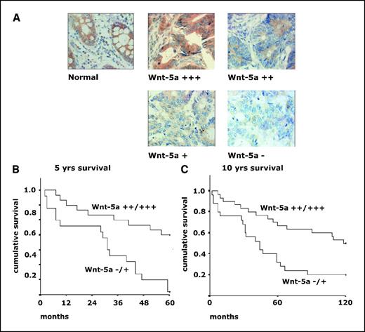Figure 1. A, immunostaining of Wnt-5a protein in normal colon tissue and representative sections of Dukes B colon carcinomas. Staining was done with a polyclonal rabbit antibody against human Wnt-5a (diluted 1:200). Magnification, ×400. Kaplan-Meier analysis of overall 5-year (B) and 10-year (C) survival of patients diagnosed with Dukes B colon cancer stratified by expression of Wnt-5a protein.