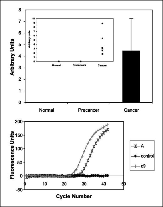 Figure 1. Aromatase expression is induced in cervical carcinomas. Normal cervical tissues, precancerous samples, and cervical carcinomas were examined for aromatase expression by conventional RT-PCR using conditions described in Materials and Methods. Columns, densitometric analysis of aromatase PCR products normalized to the housekeeping gene actin (top). Inset, distribution of aromatase mRNA expression levels (top). Aromatase expression was confirmed in two representative carcinoma samples (A, C9) using real-time RT-PCR (bottom). Note that no amplification curve was detected for the normal control, suggesting a lack of detectable aromatase mRNA, whereas amplification curves for the carcinoma samples indicate detectable aromatase expression (bottom).