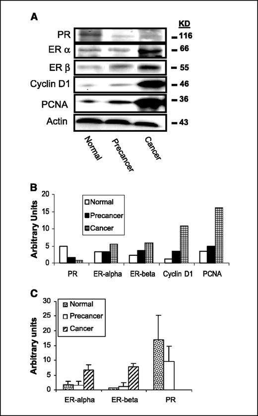 Figure 2. Aromatase expression in cervical carcinomas coincides with increased ER and decreased PR expression. A, Western blot analysis from representative normal and precancerous tissue and carcinoma sample overexpressing aromatase; right, molecular weight of each protein in kilodaltons (kDa). B, columns, densitometric analysis of Western blot data to quantify protein levels normalized to housekeeping gene actin. C, RT-PCR was used to detect mRNA expression levels of steroid receptors in normal, precancerous, and cancerous tissues; columns, densitometric analysis of PCR products normalized to that of actin. Steroid receptor and cell proliferation protein levels were tested in all aromatase-positive tumor samples (n = 5) along with the same number of normal and neoplastic tissues.