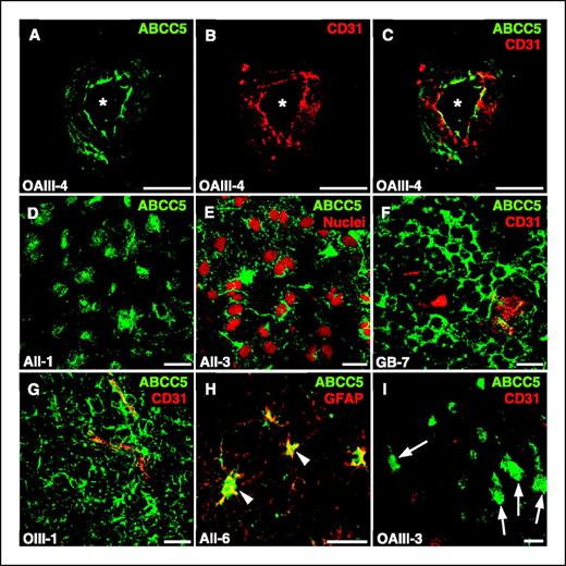 Figure 2. Immunolocalization of ABCC5 in human glioma samples. Confocal laser scanning micrographs of cryosections stained with the affinity-purified AMF antibody (A and C-I, green). Labeling of endothelial cells was done with an antibody detecting the endothelial marker CD31 (B, C, F, G, and I, red) and that of nuclei with propidium iodide (E, red). A to C, localization of ABCC5 in a capillary of a malignant oligoastrocytoma, particularly in the luminal membrane of the endothelial cells. Expression of ABCC5 in gemistocytic (D) and fibrillary (E) glioma cells of diffuse astrocytomas and in the tumor cells of a glioblastoma (F) and a malignant oligodendroglioma (G). ABCC5 was also observed in reactive astrocytes (H, arrowheads) and in neurons (I, arrows). H, the astrocytic nature of the cells was shown by double labeling with GFAP (red), yielding the yellow merged color. Asterisk, capillary lumen. Bar, 25 μm.