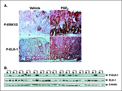 Figure 5. PGE2 induces activation of ERK and Elk-1 in vivo. A, PGE2 induces activation of ERK and Elk-1 in the intestinal adenomas of Apcmin mice. Sections of small intestine were immunostained with phospho-ERK1/2 antibody (top) or phospho-Elk-1 antibody (bottom). Representative section of strong immunoreactive staining (red) for phospho-ERK1/2 or phospho-Elk1 in the epithelial cells of the adenomas taken from mice treated with PGE2 and weak staining was found in the adenomas taken from mice treated with vehicle. Bar, 100 μm. B, Elk-1 activation in human colon tumor and matched normal tissue. Whole cell protein lysates from 15 different matched pairs of normal (N) and cancer tissue (T) were analyzed for Elk-1 phosphorylation and expression by using immunoblot analysis. Each blot was subsequently reprobed for β-actin to evaluate protein loading.