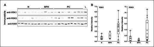 Figure 1. RSK levels are higher in human prostate cancer tissue. A, denatured tissue lysates were normalized to RAN and the normalized aliquots immunoblotted. Subset of the PC samples. B, immunoblots were quantitated by densitometry (21) and intensities plotted as a box-and-whisker plot (45). Bar in the box is at the statistical median and ends of the box are at the upper and lower quartiles. N, normal tissue (n = 7); BPH, benign hyperplastic prostate tissue (n = 4); PC, prostate cancer tissue (n = 13); L, LNCaP cell line.