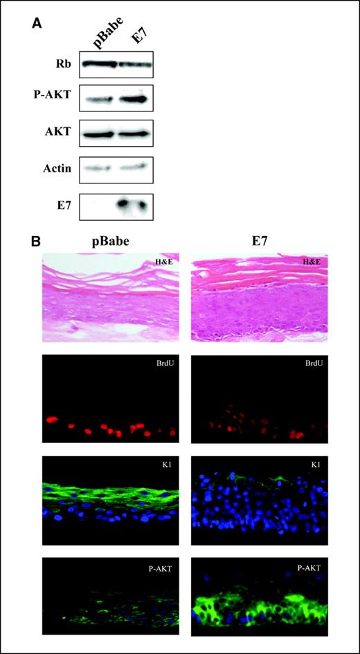 Figure 1. HPV-16 E7 up-regulates AKT activity in primary human keratinocytes (HFK). A, primary HFKs were transduced with retrovirus expressing HPV-16 E7 or vector control and Western blots were carried out to determine Rb, phosphorylated AKT (P-AKT), AKT (total), and E7 levels. Actin is a loading control. B, same cells were differentiated on organotypic raft cultures for 14 days. Cells were pulsed with 20 μmol/L BrdUrd 12 hours before harvesting rafts. The rafts were then fixed, paraffin embedded, sectioned, and stained for BrdUrd (red), keratin-1 (K1; green), phosphorylated AKT (green), and DAPI (blue) to stain nuclei. H&E-stained sections for both cell lines to examine morphology.