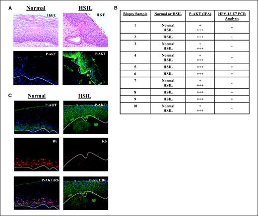 Figure 4. HPV-positive cervical biopsies with HSILs have up-regulated AKT activity and Rb loss. A, cervical biopsy #4 section exhibiting normal or HSIL morphology based on H&E staining were immunostained for active AKT. Phosphorylated AKT is stained with FITC (green), whereas nuclei are stained with DAPI (blue). B, phosphorylated AKT staining in HSIL was compared with normal areas within the biopsies. Each biopsy was given a sample number (1-10) and scored for high (+++) or low (+) phosphorylated AKT immunostaining within normal and/or HSIL areas within the samples. DNA was also isolated from each biopsy, and PCR analysis was carried out to look for the presence (+) or absence (−) of HPV-16 E7. C, normal and HSIL tissue from cervical biopsy #4 were stained for Rb (red), phosphorylated AKT (green), and DAPI (blue) to stain nuclei. Overlay of Rb (red), phosphorylated AKT (green), and DAPI (blue) staining.