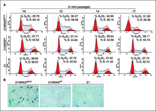 Figure 3. Accumulation in the G0-G1 phase of the cell cycle and expression of a senescence-associated marker in BRAFV600E melanoma cells with constitutive NRASQ61R expression. A, cell cycle analysis of 21NRASQ61R cells, compared with 21NRASWT and with parental 21 cells between the 10th and the 17th in vitro passage. B, SA-β-Gal staining of the parental 21 line, of 21NRASQ61R cells, and 21NRASWT (both at the 14th in vitro passage).