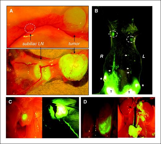 Figure 1. Whole-body and intravital images of ZsGreen-expressing ER+ human breast cancer cells and their LN metastases. A, excised abdominal mammary gland from a 3-day-old MCF-7 tumor, in relation to the subiliac LN (top, dashed circle), and from a 12-week-old MCF-7 tumor with a LN metastasis at a similar site (bottom). B, whole-body image showing bilateral T47D tumors (T), subiliac LN metastases (*), collecting LV (arrows), and axillary LN macrometastases (right) and micrometastases (left; dashed circles). C, intravital image of MCF-7 axillary LN metastasis showing a micrometastasis (left) and a macrometastasis (right) with a collecting LV draining into it. D, intravital image of an MCF-7 metastasis to the left para-aortic LN (left) and more progressive disease showing coalesced left and right para-aortic LNs and further tumor spread caudally to the renal LNs (right).