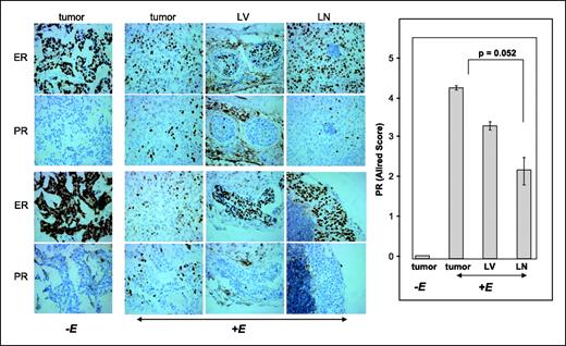 Figure 6. ER and PR expression in triads of MCF-7 tumors, LV emboli, and LN metastases. Left, representative images of two tumors from placebo (−E) treated mice and of two matched triads of estradiol-treated (+E) mice, showing tumors, their lymphatic emboli, and LN metastases. Paraffin-embedded sections were probed with mouse anti-ER or mouse anti-PR primary antibodies, coupled with goat anti-mouse HRP-conjugated secondary antibodies. Right, quantification of PR expression in placebo-treated (n = 3) and estradiol-treated tumors (n = 7), LV emboli (n = 3), and LN metastases (n = 5), based on the intensity of cellular staining combined with the percent of positive cells.