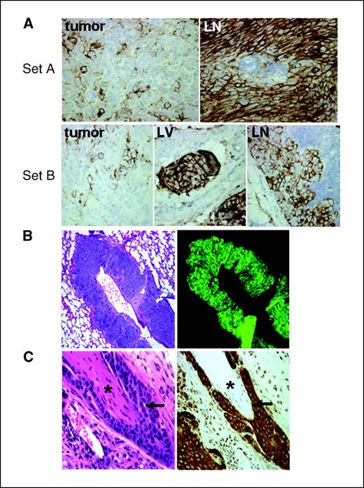 Figure 7. Selection of CD44+ MCF-7 tumor cells for lymphatic transit and examples of lung metastases and perineurial invasion. A, tumors (n = 5) taken from estradiol-treated mice, and their matched LV (n = 3) and/or LNs (n = 6), were probed with mouse anti-CD44 and goat anti-mouse HRP-conjugated secondary antibodies. Top, a tumor and its matching LN. Bottom, a triad of tumor, LV, and LN taken from the same mouse. B, left, H&E stain of a paraffin-embedded section of T47D cells from an estradiol-treated mouse with metastasis to the lung. Right, a serial section processed for fluorescence microscopy. C, left, H&E stain of MCF-7 tumor cells from an estradiol-treated mouse showing perineurial invasion. Right, CK18 stain of a deeper section. *, nerve; arrow, tumor cells.