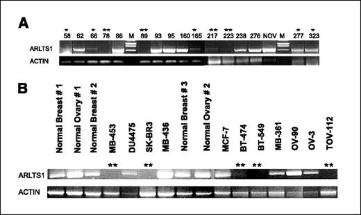 Figure 1. ARLTS1 expression in various normal and malignant samples. A, expression in ovarian carcinomas by RT-PCR. B, expression in ovarian and breast cancer cell lines by RT-PCR. One asterisk, reduction by at least 66%; two asterisks, reduction with >90% from that in normal samples as measured with the GelDoc quantification software. NOV, normal ovary (Ambion sample 2); M, 1 kb marker.
