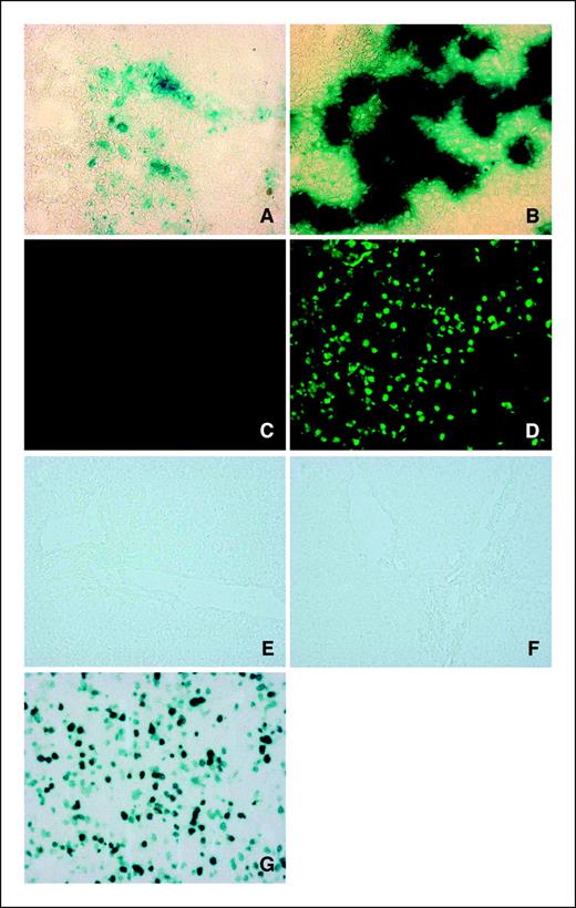 Figure 4. Gene transfer efficiency and induction of apoptosis by hybrid vectors in Huh-7 tumors. Human Huh-7 tumors established in nude mice were treated by intratumoral injection of HC-Ad-AFP-LacZ (n = 4) or HC-Ad-AFP-SFV-LacZ (n = 4) at 1 × 1010 vp/animal. Three days after virus administration, mice were sacrificed and tumor and liver sections were analyzed for transgene expression by X-Gal staining and for cell apoptosis by TUNEL. A and C, microphotographs from tumors receiving HC-Ad-AFP-LacZ. B and D, microphotographs from tumors receiving HC-Ad-AFP-SFV-LacZ. A and B, stained by X-Gal; C and D, stained by TUNEL. Original magnification, ×200. E to G, specificity of hybrid vectors in vivo. BALB/c mice were administered i.v. with HC-Ad-AFP-LacZ (n = 4), HC-Ad-AFP-SFV-LacZ (n = 4), or AdCMV-LacZ at 1 × 1010vp/animal. Liver sections were stained with X-Gal. E to G, representative photomicrographs from liver sections of animals receiving HC-Ad-AFP-LacZ, HC-Ad-AFP-SFV-LacZ, or AdCMV-LacZ, respectively. Original magnification, ×200.