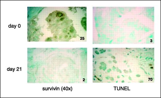 Figure 7. Survivin protein is inhibited in patients with ErbB2-overexpressing breast cancer who respond to lapatinib. Survivin protein expression in tumor tissue was assessed by quantitative immunohistochemistry before (day 0) and after 21 days of lapatinib therapy. The numbers shown indicate the absorbance value attributed to the intensity of staining (see Materials and Methods). TUNEL staining was done on the same tumor tissue. The numbers indicate the percentage of cells staining positive for TUNEL before (day 0) and after 21 days of lapatinib therapy. Representative of ErbB2-overexpressing breast cancer patients who responded clinically to lapatinib (35).